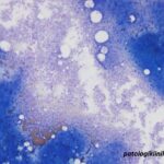 Atypical Chronic Myeloid Leukemia (aCML)