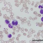 Atypical Chronic Myeloid Leukemia (aCML)