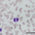 Atypical Chronic Myeloid Leukemia (aCML)