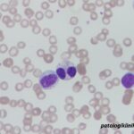Atypical Chronic Myeloid Leukemia (aCML)