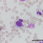 Atypical Chronic Myeloid Leukemia (aCML)