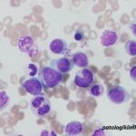 Atypical Chronic Myeloid Leukemia (aCML)