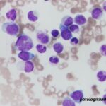Atypical Chronic Myeloid Leukemia (aCML)