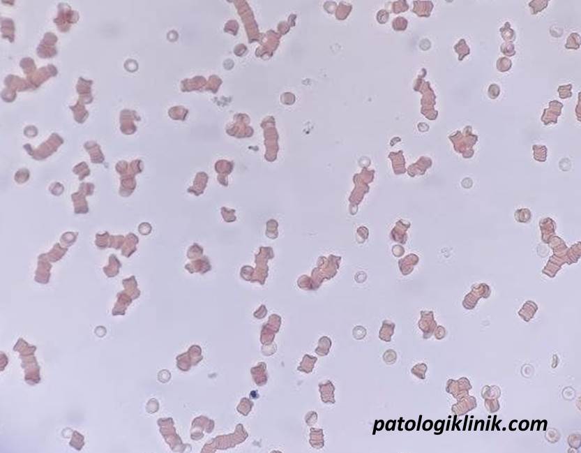 Saline Dilution Test untuk Membedakan Formasi Rouleaux dengan Autoaglutinasi