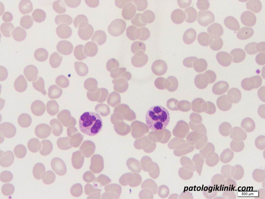 Saline Dilution Test untuk Membedakan Formasi Rouleaux dengan Autoaglutinasi