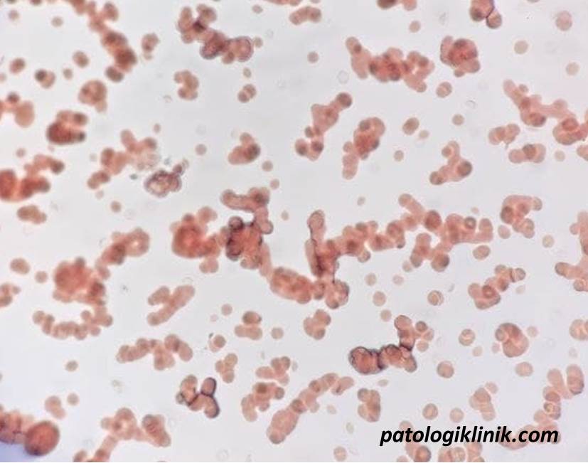 Saline Dilution Test untuk Membedakan Formasi Rouleaux dengan Autoaglutinasi