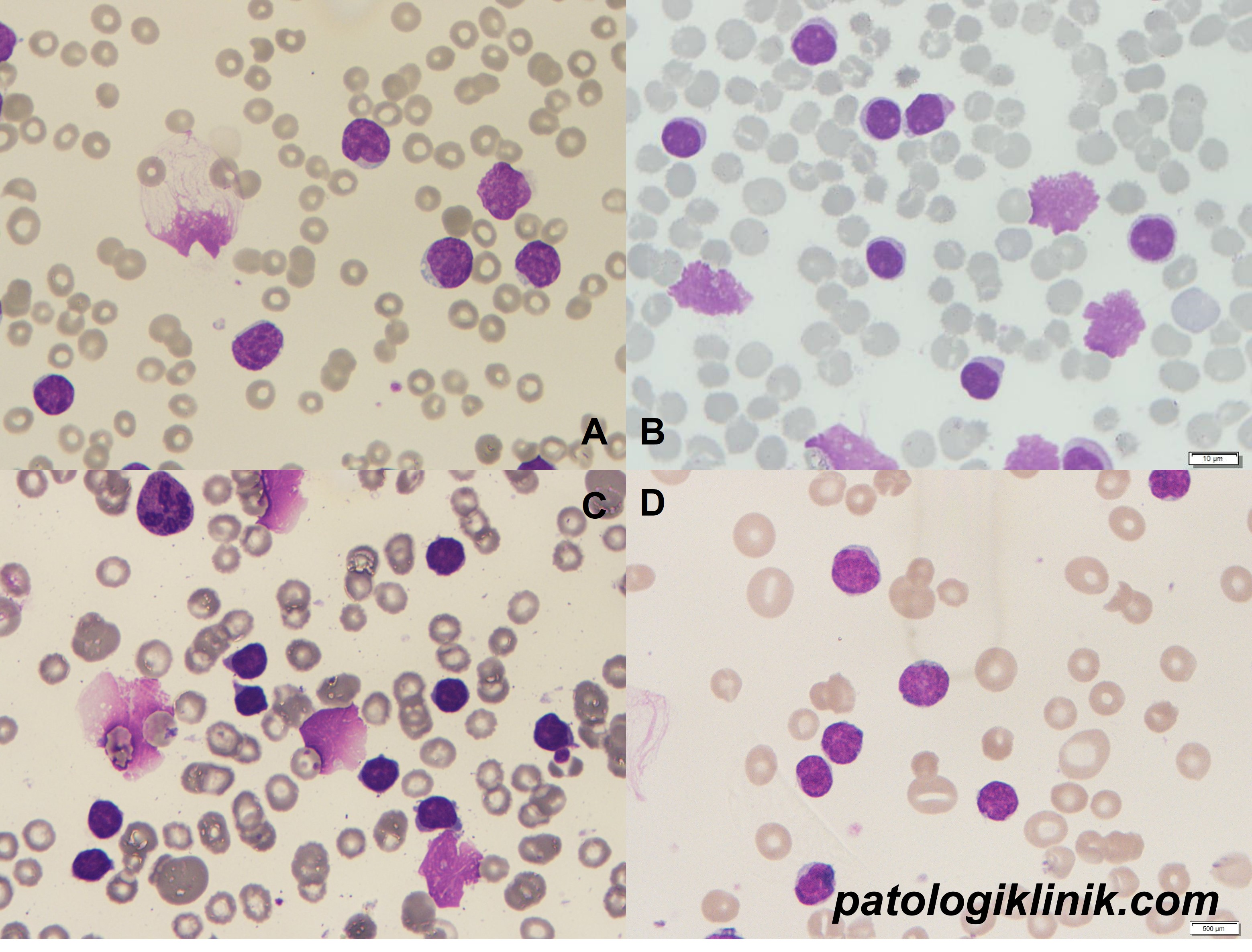 Smudge Column Menghitung Smudge Cells pada Pasien CLL