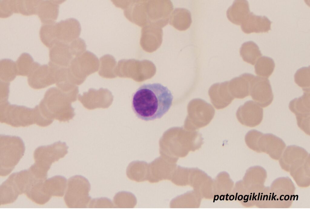 Kriteria Diagnosis Leukemia Sel Plasma Terbaru (IMWG 2021)